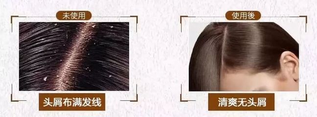 告別脫發(fā)、頭皮屑與頭發(fā)稀少的煩惱，重塑烏黑濃密的秀發(fā)